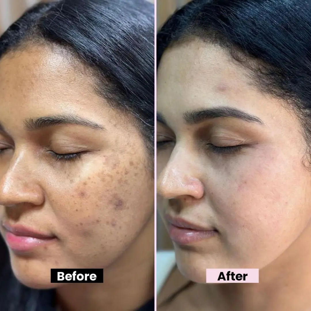 Chalonese Brightening Cream | (Both for Men & Women)